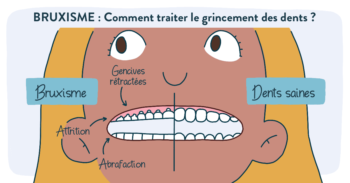 Bruxisme : tout savoir avant de consulter