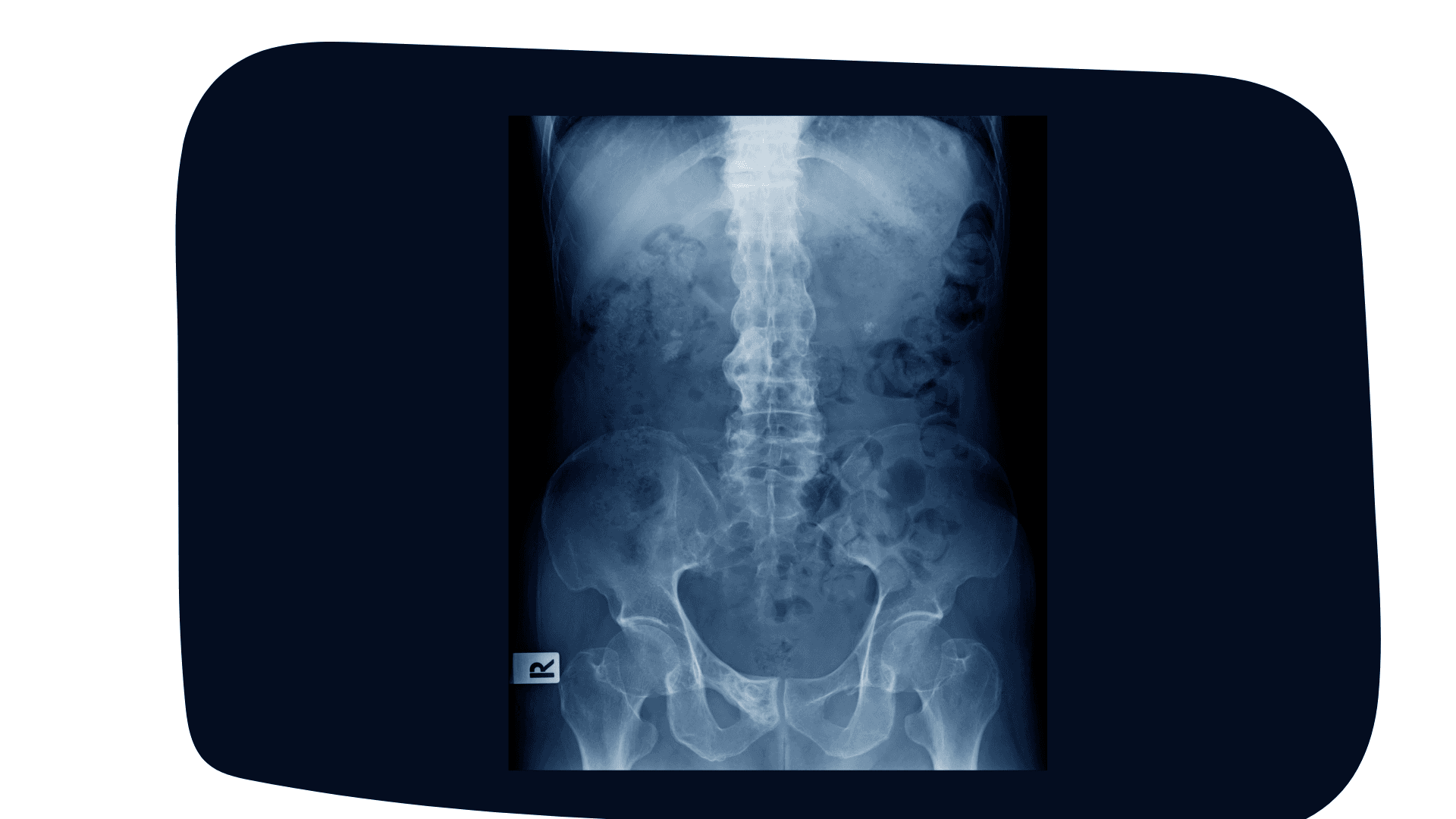 La spondylarthrite ankylosante, symptômes et traitements