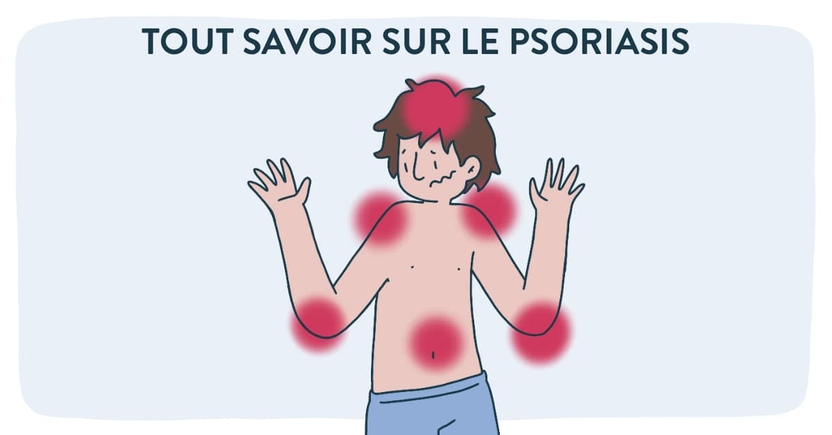 Psoriasis : causes, symptômes, traitements. À savoir avant de consulter