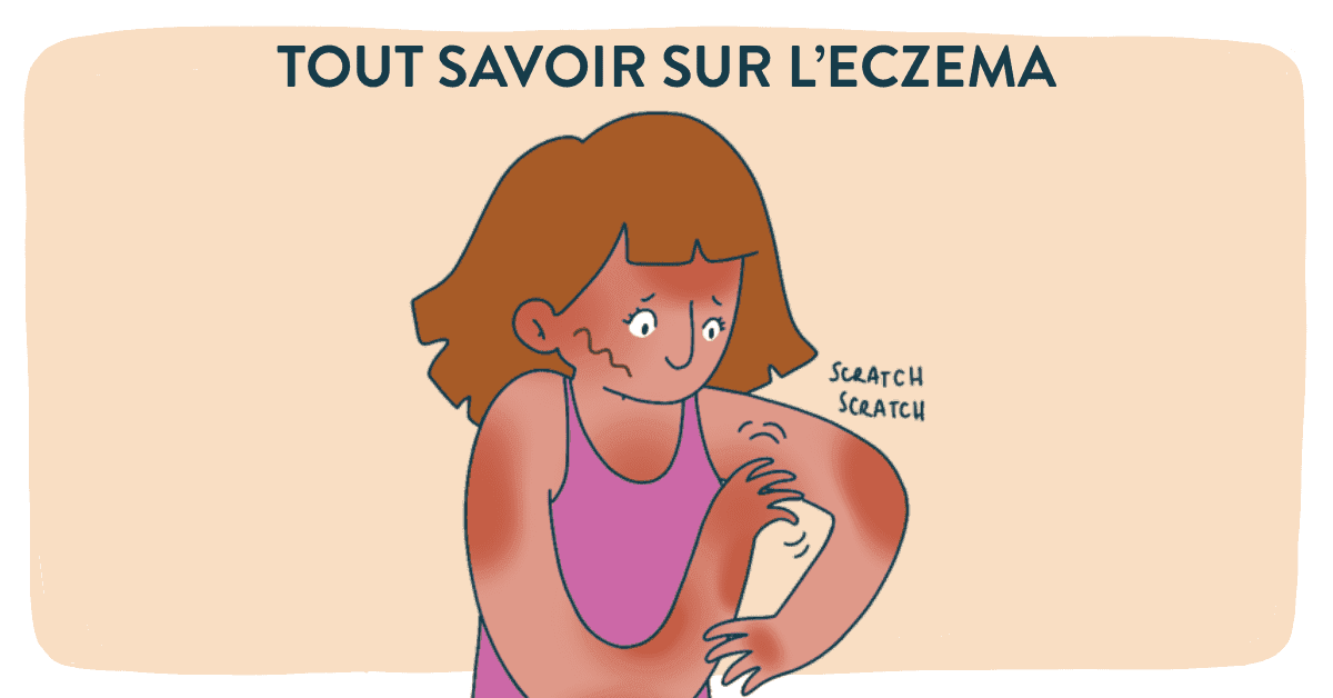 L’eczéma : quels sont les causes et symptômes
