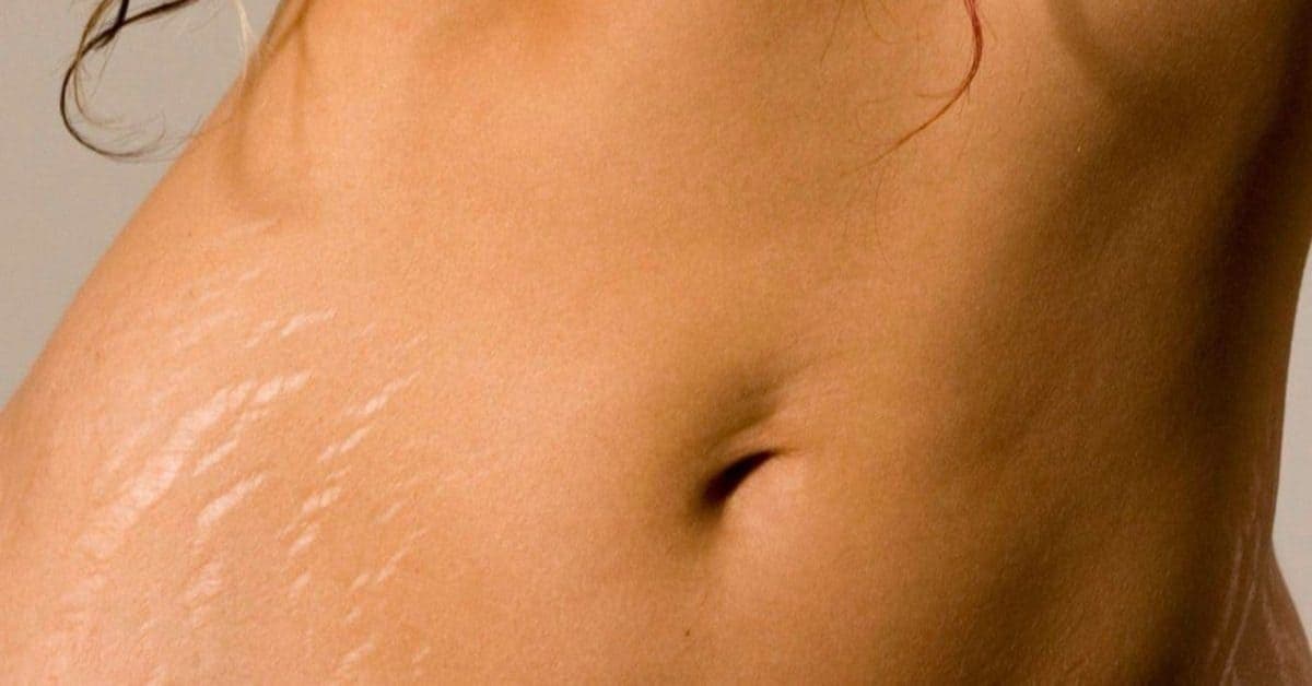Les vergetures : s’en débarrasser ou vivre avec ?