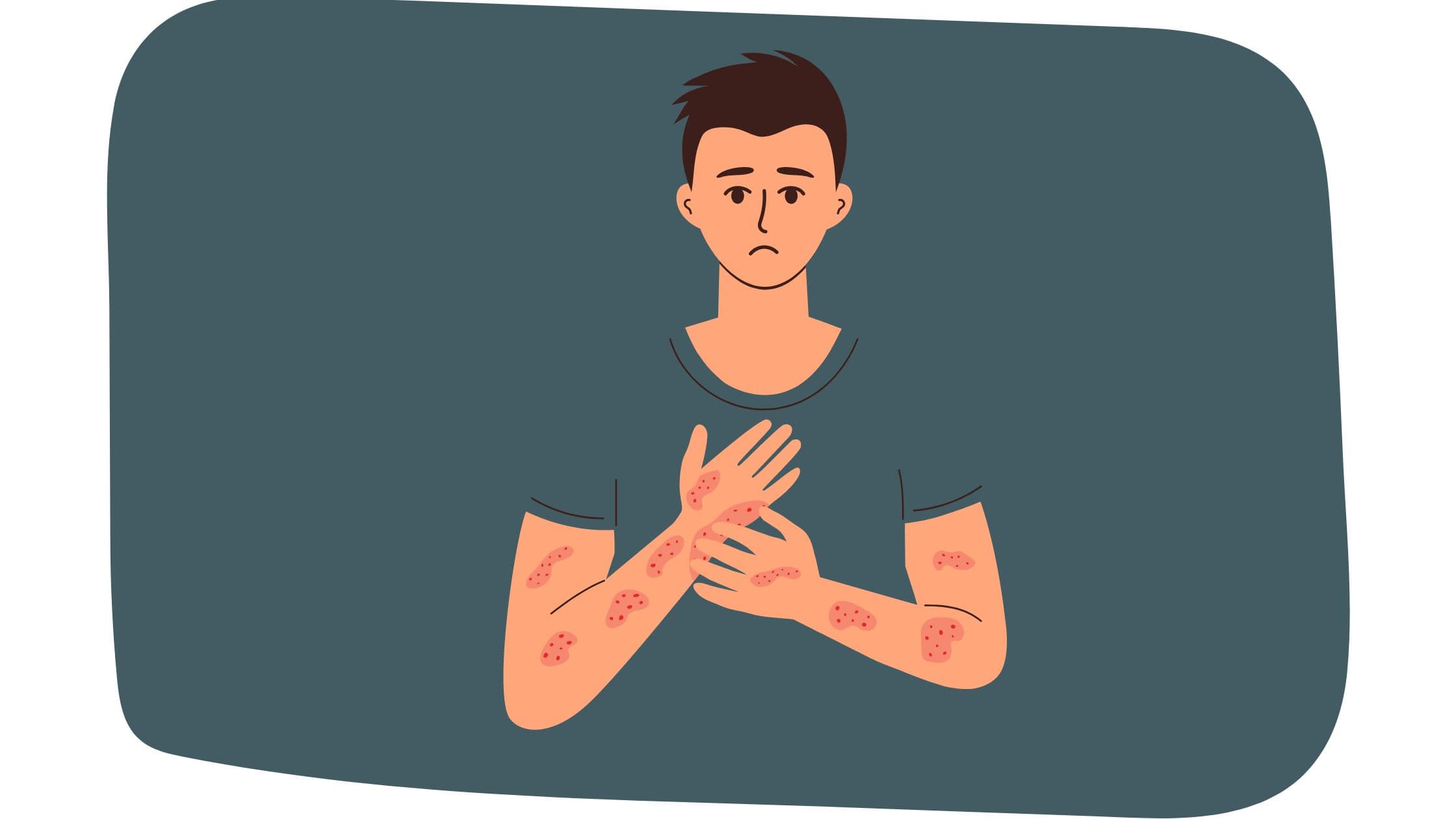 Eczéma chez l’adulte : pourquoi apparaît-il et que faire pour le traiter