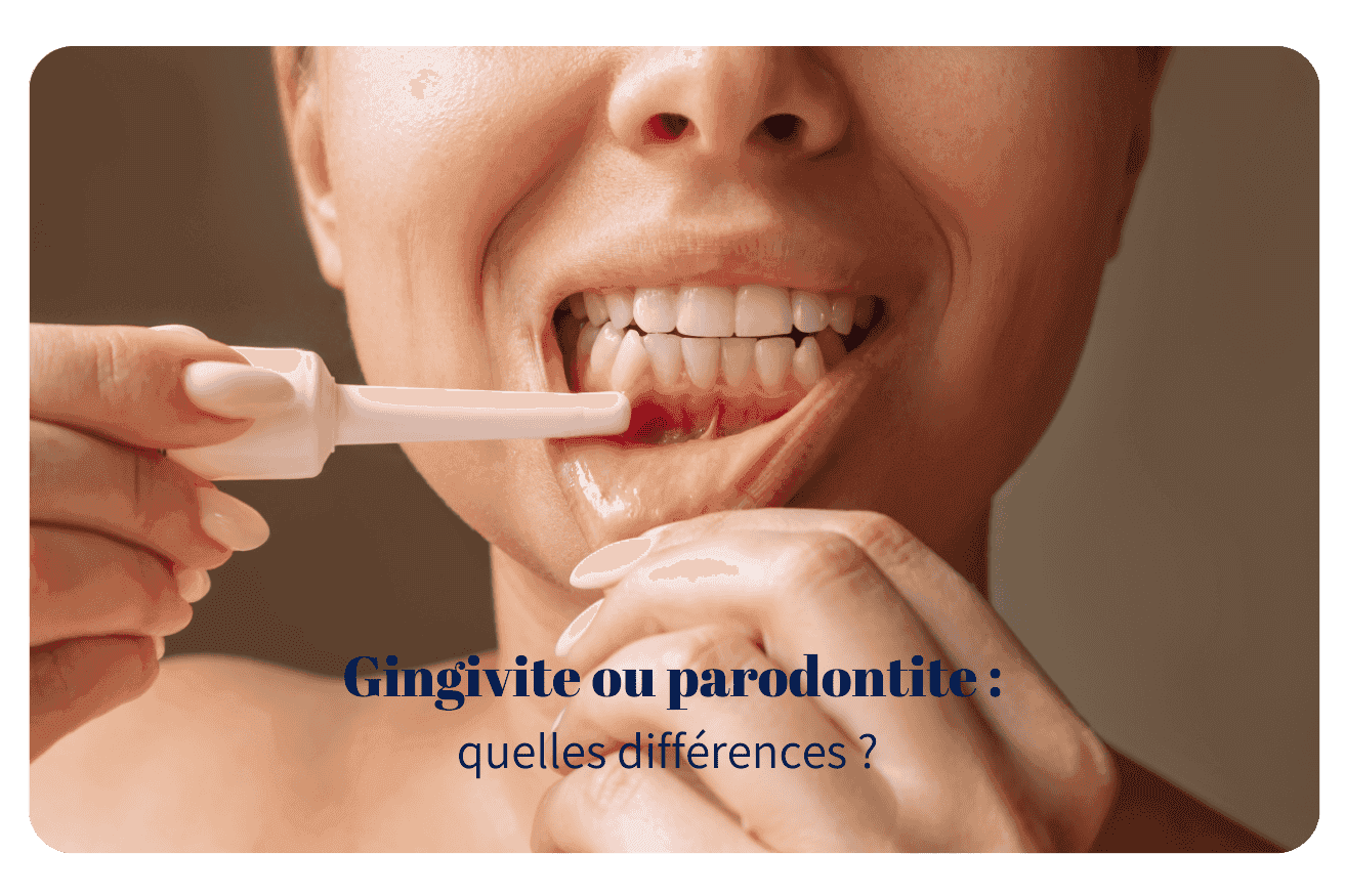 Quelles différences entre gingivite et parodontite