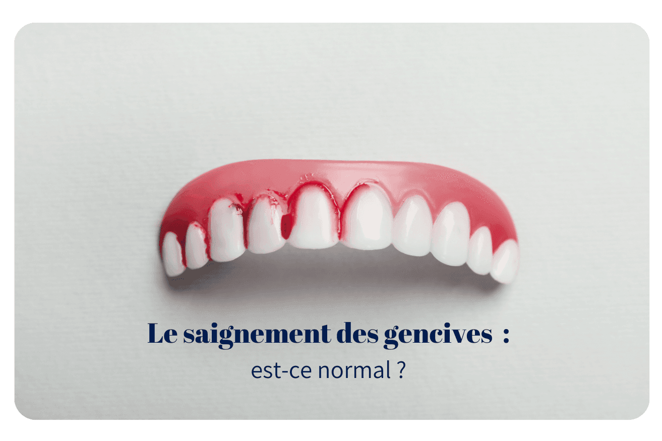 Le saignement des gencives, est-ce normal ?