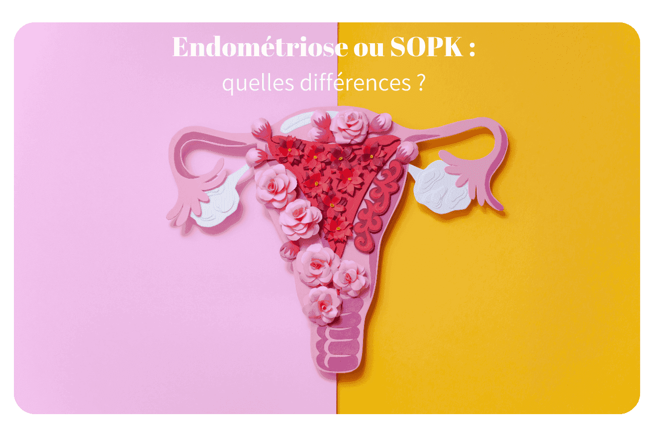 Les symptômes clés pour différencier endométriose ou sopk
