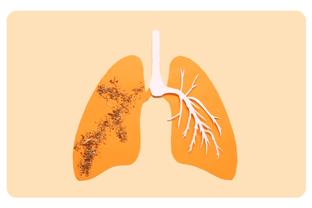 Fibrose pulmonaire : causes, symptômes et traitements