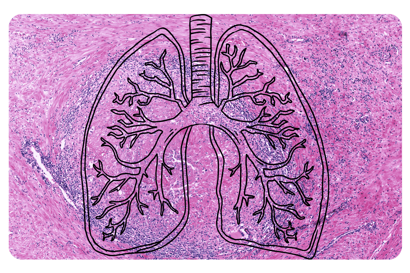 Maladies pulmonaires interstitielles : causes, symptômes et traitements