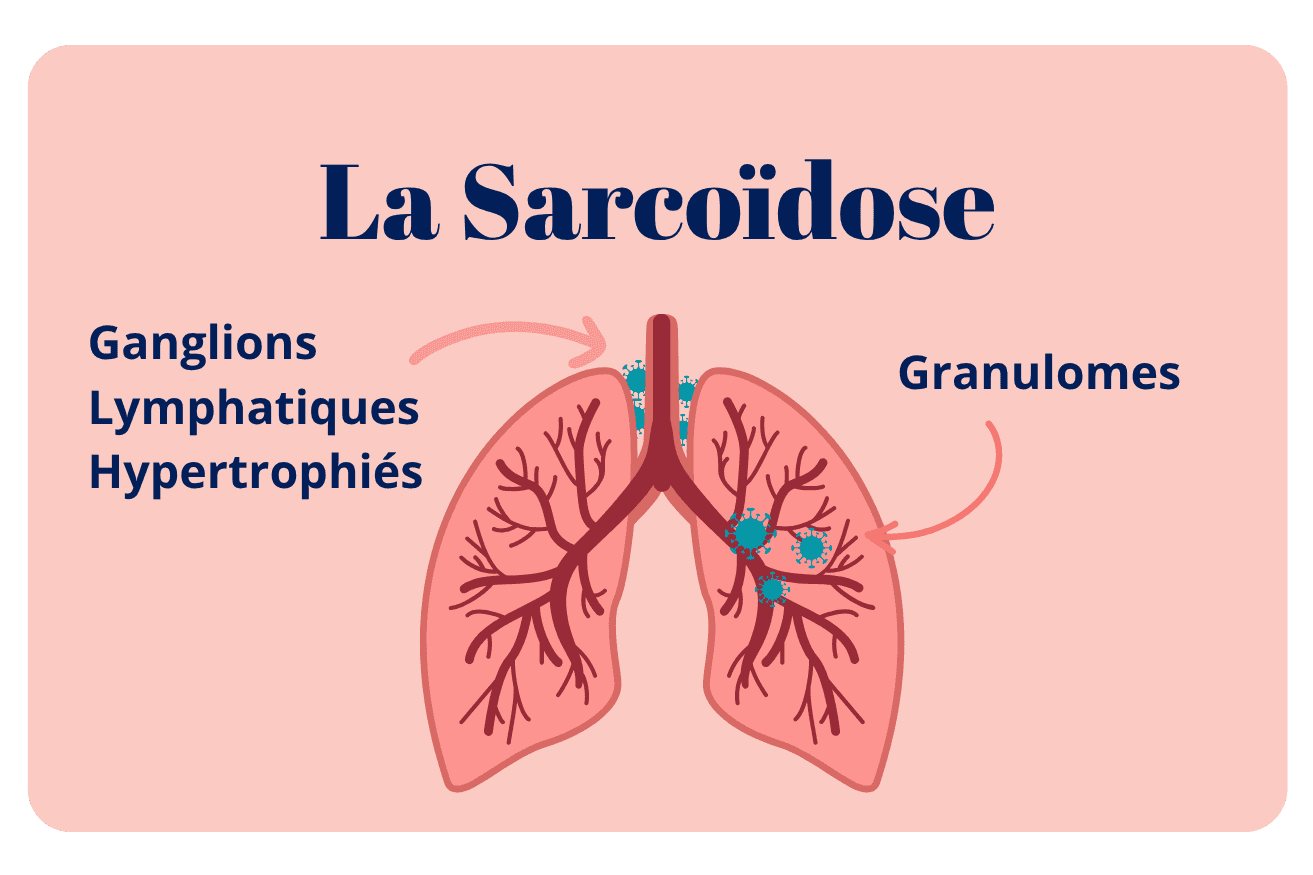Sarcoïdose : Symptômes, Diagnostic et Traitement de cette Maladie Inflammatoire