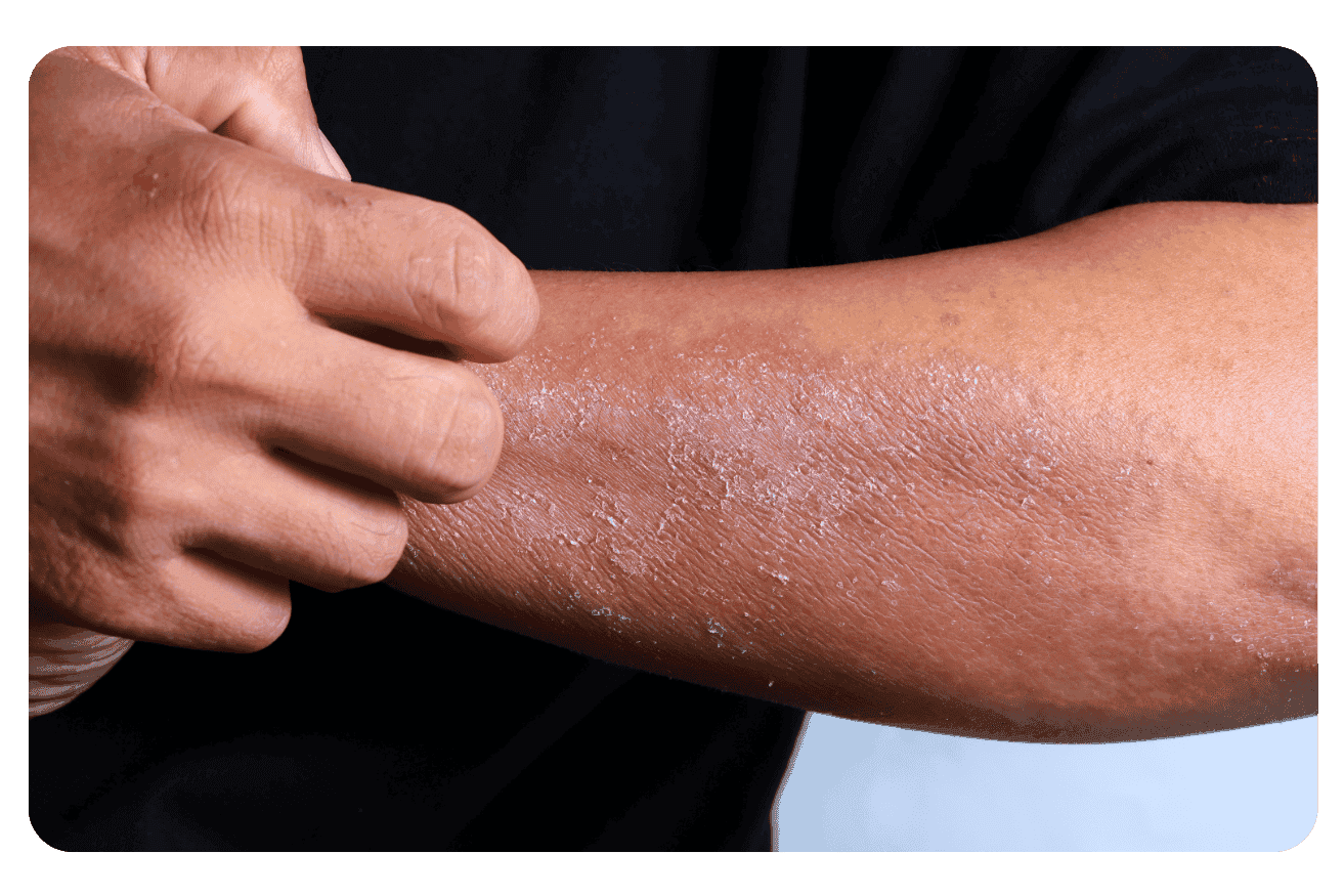Maladies auto-immunes de la peau : Symptômes, diagnostic et traitements