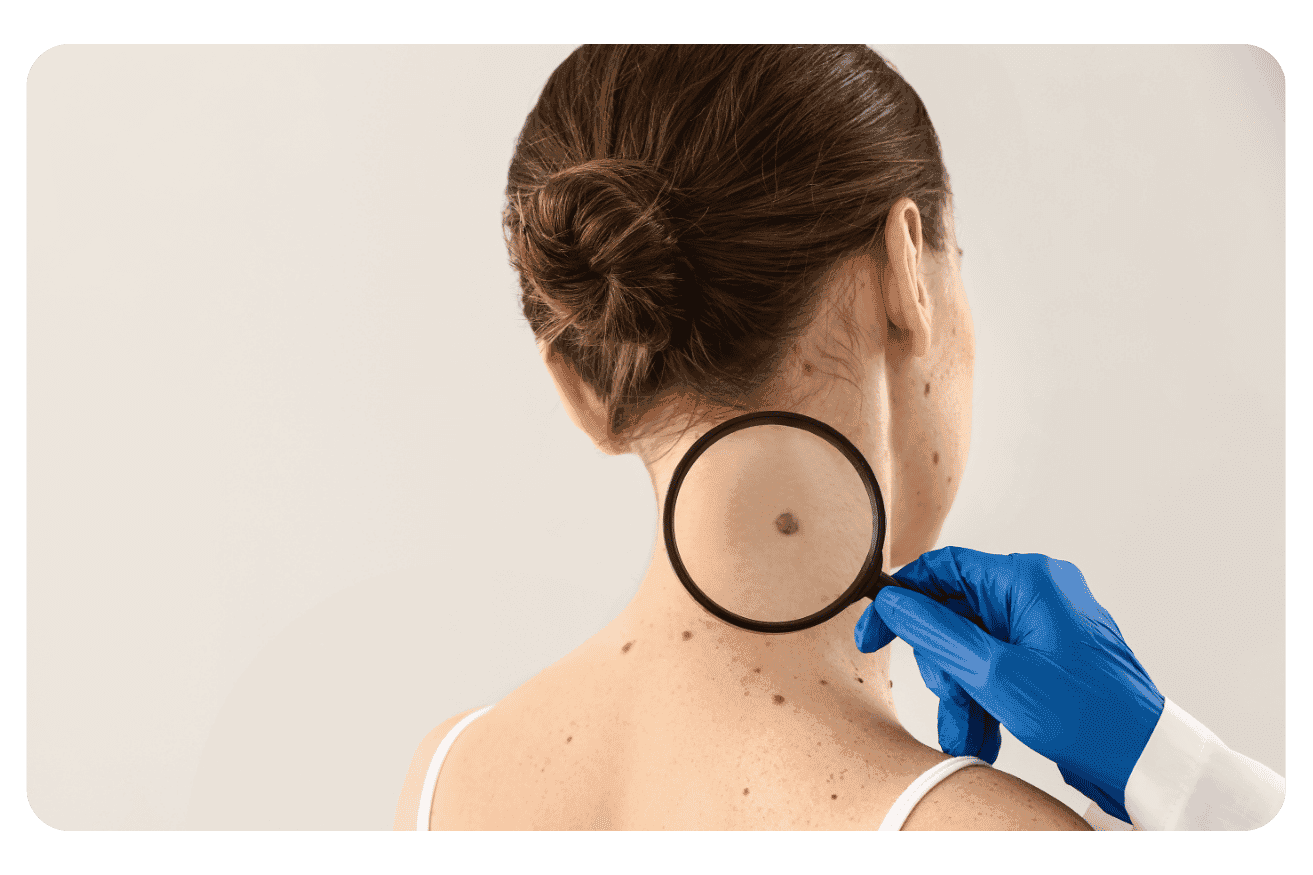 Cancers de la peau : prévention et dépistage du mélanome