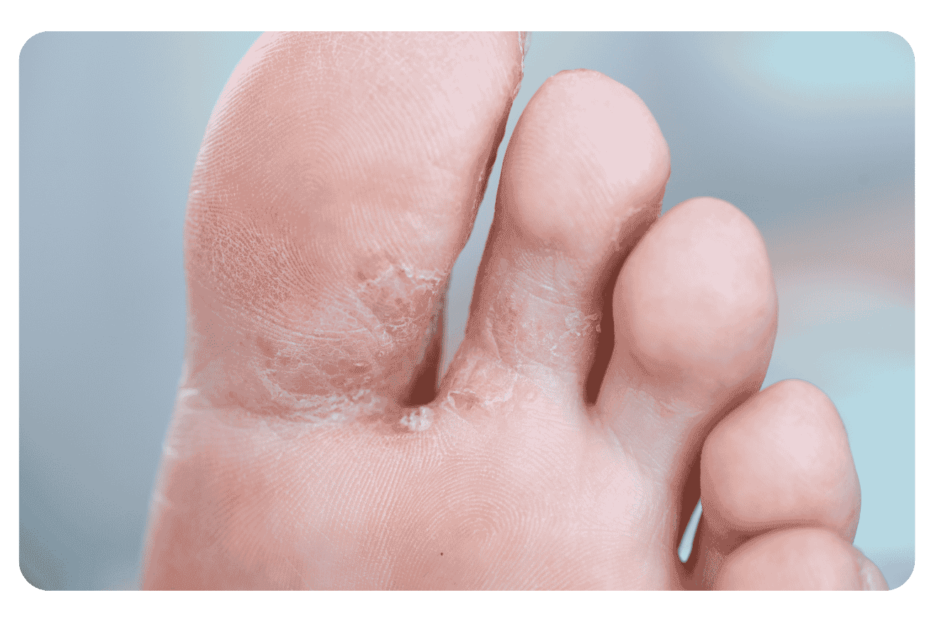 Mycose des pieds : prévention en piscine et en vacances