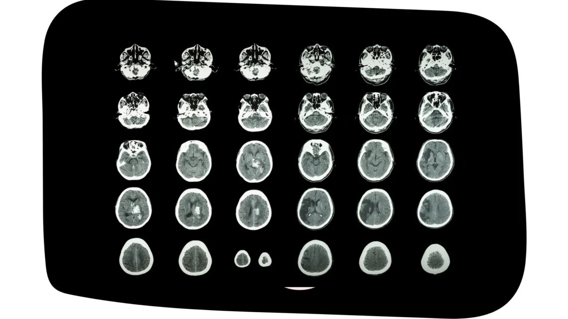 AVC chez les hommes et les femmes