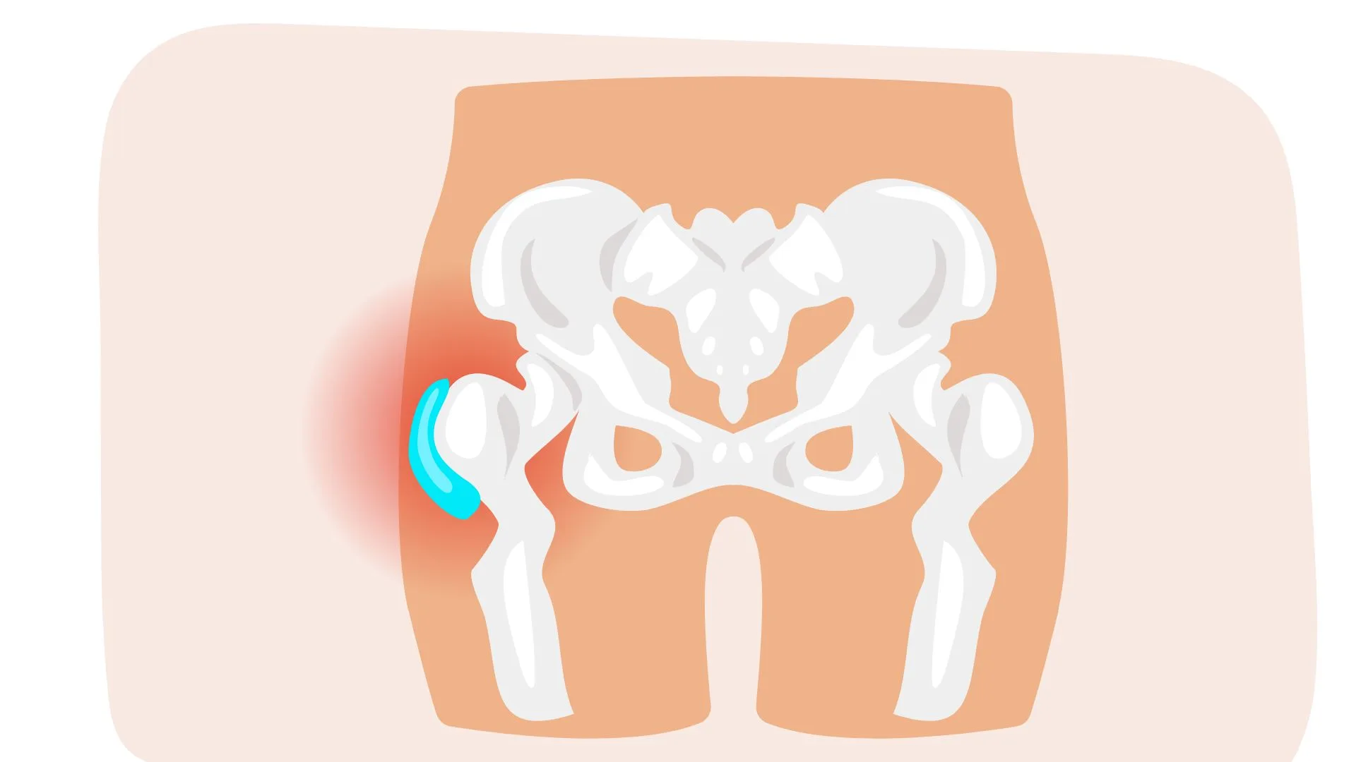 Les différentes formes de spondylarthrite