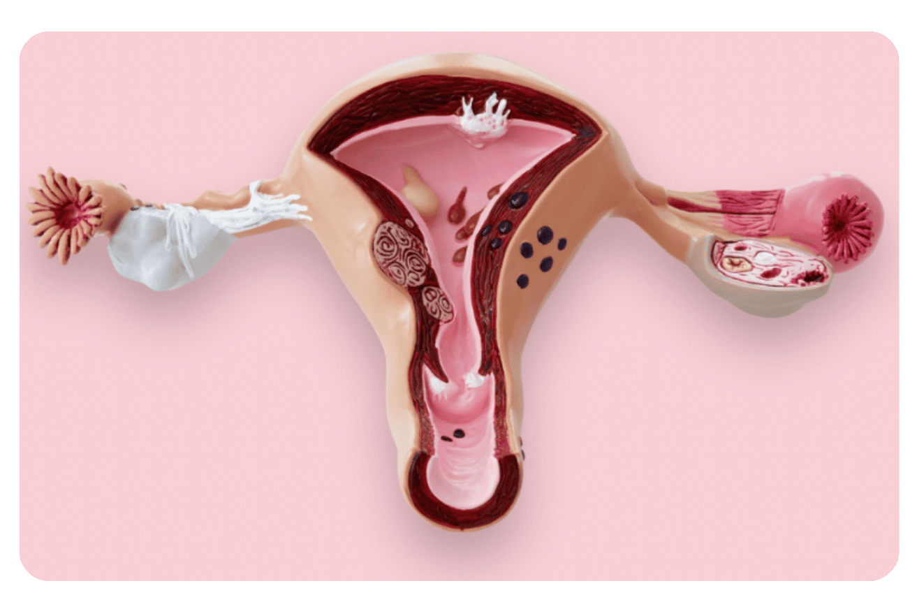 SOPK : Comprendre et Traiter le Syndrome des Ovaires Polykystiques